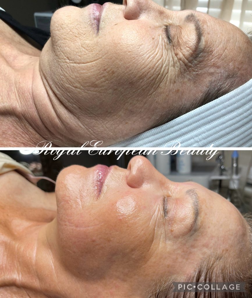 A split image shows the same person's face in a side profile view before and after a cosmetic treatment. In the 'before' photo (top), the skin has visible wrinkles and a sagging appearance. In the 'after' photo (bottom), the skin appears smoother, tighter, and more rejuvenated. Text on the image reads “Royal European Beauty.”.