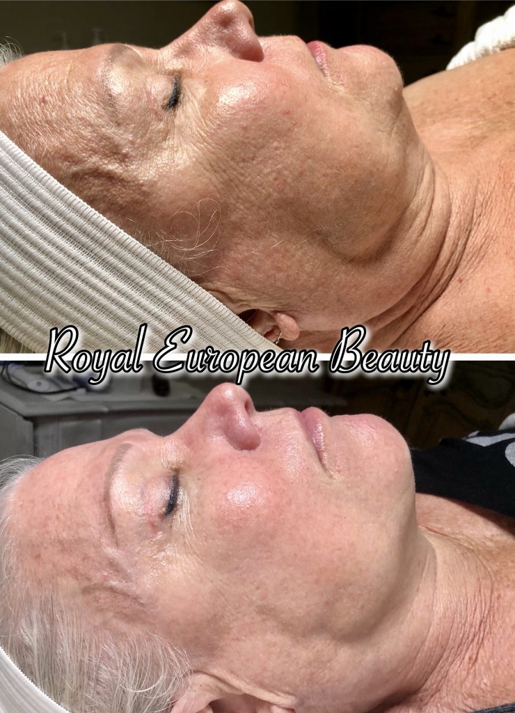 Close-up side-by-side images of an older woman, showing her face before and after a beauty treatment. The "before" image highlights wrinkles and sagging skin, while the "after" image shows smoother and tighter skin. Text overlay reads "Royal European Beauty.