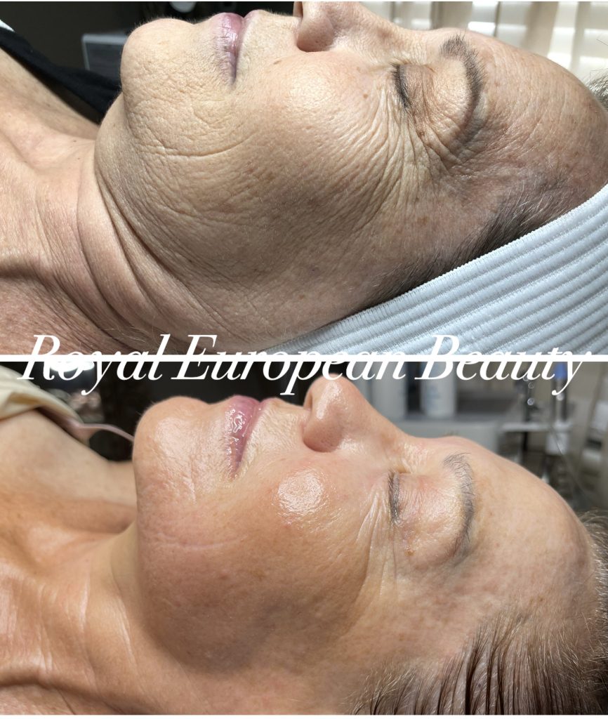 An image showing a side-by-side comparison of the same woman's face before and after a skincare treatment. In the "before" picture, she has more visible wrinkles and uneven skin tone. In the "after" picture, her skin appears smoother and more radiant. The text "Royal European Beauty" is written across the middle of the image.