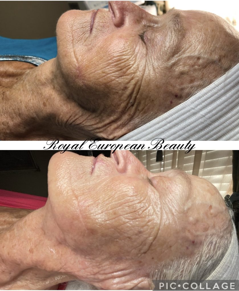 Two side-by-side images show a close-up of an older person's face before and after a beauty treatment. The top image presents the face with more wrinkles and fine lines. The bottom image depicts a noticeable reduction in wrinkles, with smoother and more refreshed skin.